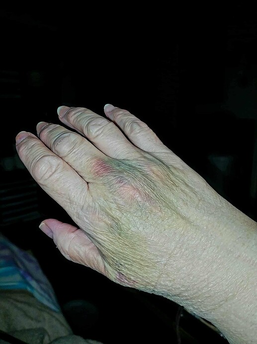 bruise